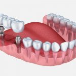 Протезирование зубов: современные методы восстановления здоровья улыбки